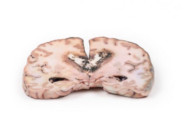 https://jayakelana.id/uploads/product/-mp2003-glioma-grade-3-4--15959f8d55a3304_cover.jpg