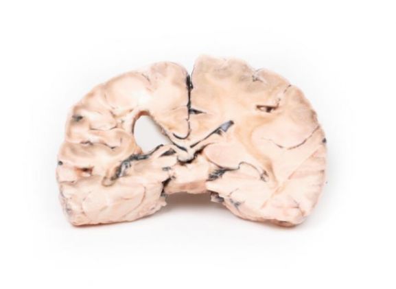 https://jayakelana.id/uploads/product/-mp2005-left-cerebral-infarct-79391d7c5ffe427_cover.jpg