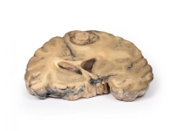 https://jayakelana.id/uploads/product/-mp2007-metastatic-adenocarcinoma-in-681531e669e5ea8_cover.jpg